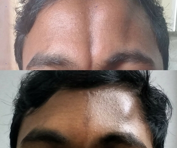 Forehead contour correction with diced cartilage grafts in fascia
